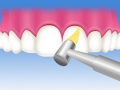 歯のクリーニング（PMTC）手順