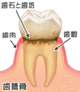 歯と歯ぐきの間に歯石や歯垢が溜まっている状態