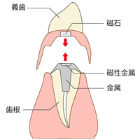 磁石付き義歯(マグネットデンチャー)